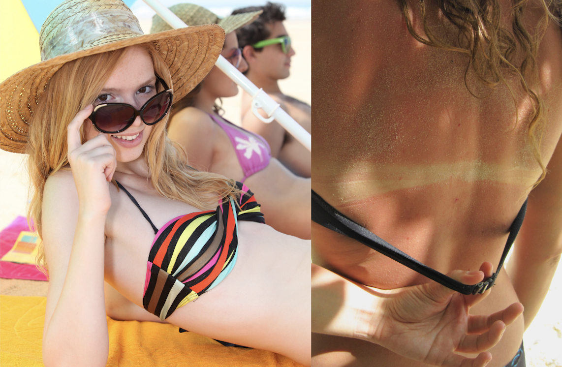 Pale Friend Risks Third-Degree Burns To Prove She Really Does Tan Well